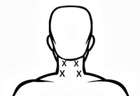 Tens unit placement for neck pain